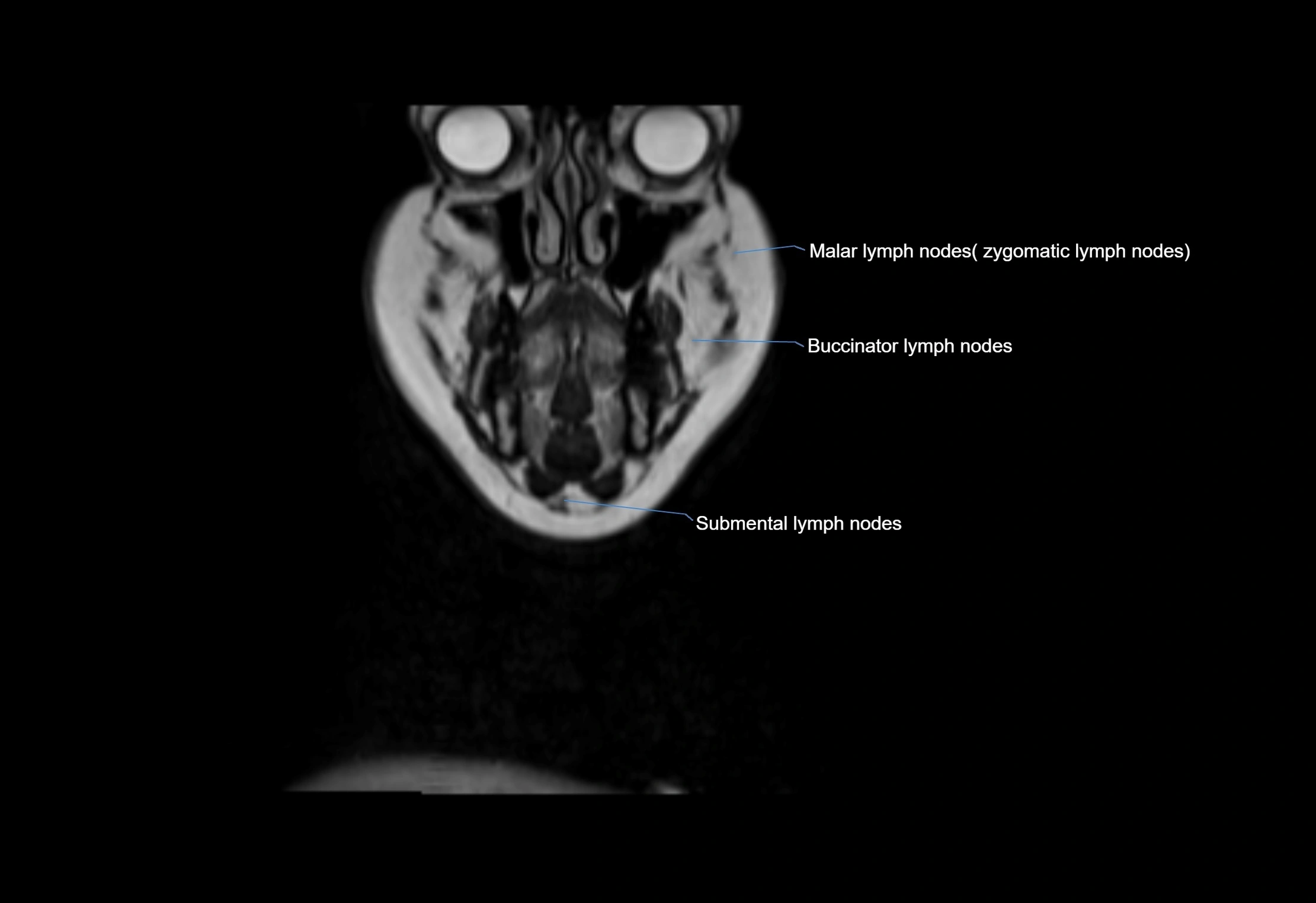 Neck coronal lymph node cross sectional MRI anatomy 3T MRI  image-img-00001-00067.webp